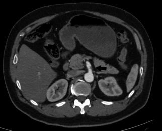 Isolated superior mesenteric artery dissection: An unusual presentation quashed by an unusual approach