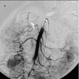 Endovascular treatment of the superior mesenteric arteriovenous fistula complicated by gastrointestinal bleeding