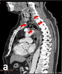 Endoscopic vacuum therapy in the late diagnosed iatrogenic esophageal perforation: The convenience of using fluoroscopy