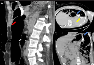 Gastrocolocutaneous fistula: An undetected complication of colon transfixation during percutaneous endoscopic gastrostomy 