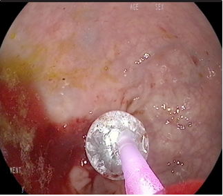 Role of endoscopic interventions and electroincision in benign anastomotic strictures following colorectal surgery