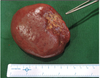 What is a disappearing intra-abdominal mass?