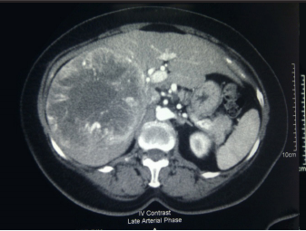 Extraneural metastasis of meningeal haemangiopericytoma to the liver