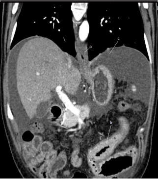 A rare case of eosinophilic esophagitis and eosinophilic subserosal gastroenteritis with ascites