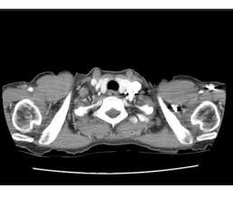 Laser treatment of congenital esophageal stenosis and web at the upper esophageal sphincter