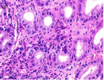 Gastrointestinal findings in 26 adults with common variable immunodeficiency: The fickle nature of the disease manifests in gastrointestinal biopsies