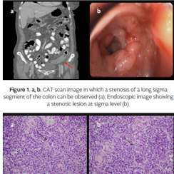 Segmental cytomegalovirus colitis mimicking sigmoid tumor in an immunocompetent patient