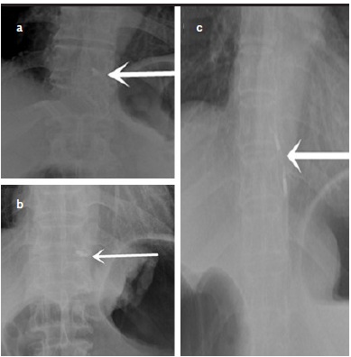 Application of preoperative endoscopic ultrasonography-guided carbon nanoparticle tattooing combined with titanium clip labeling in esophagogastric junction adenocarcinoma