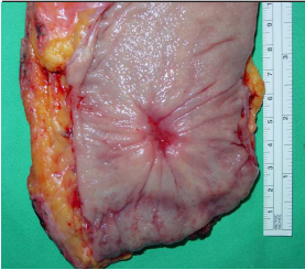 “Watch and wait” approach in rectal cancer patients following complete clinical response to neoadjuvant chemoradiotherapy does not compromise oncologic outcomes