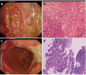 Epstein-Barr virus-associated lymphoproliferative disorder in colon with the development of hemophagocytic syndrome of an immunocompetent patient