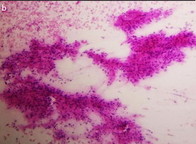 Pancreatic tuberculosis: A close mimicker of malignancy