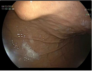 Extremely rare cause of extrinsic compression of the stomach during esophagogastroduodenoscopy