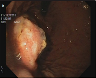 Carcinosarcoma of the stomach: A rare tumor for an unusual localization. Review of the literature