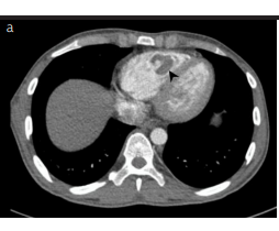 Arterial and venous thrombosis with right ventricular thrombus in Crohn’s disease