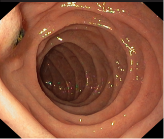 Attendance to a “normal delivery” of choledocholithiasis