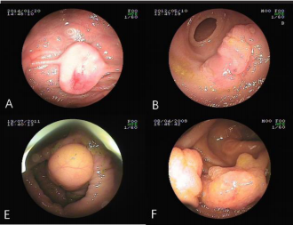 Clinical characteristics of small bowel tumors diagnosed by double-balloon endoscopy: Experience from a Chinese tertiary hospital