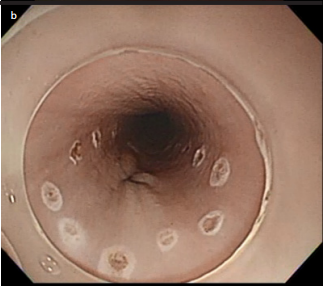 Efficacy of traction, using a clip-with-thread, for esophageal endoscopic submucosal dissection for esophageal lesions with fibrosis in an ex vivo pig training model