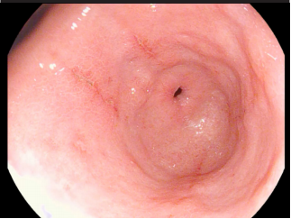 An unusual gastric biopsy