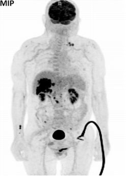 The Role of 18F-FDG PET/CT in staging of gallbladder carcinomas