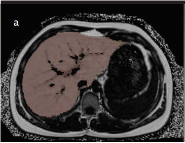 Analysis of correlation between liver fat fraction and AST and ALT levels in overweight and obese children by using new magnetic resonance imaging technique