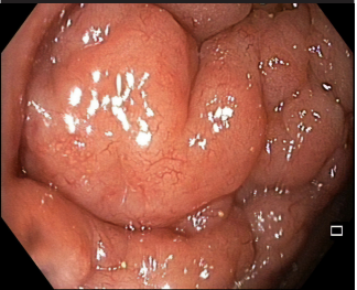 The first report of colonic involvement of angioimmunoblastic T-cell lymphoma