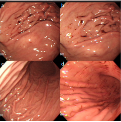 Acute gastric injury after ingestion of substrate with hyperosmolar glucose and benzoate inversely related with small intestinal bacterial overgrowth